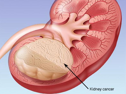 Kidney Cancer