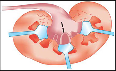 Open Surgery (Pyelolithotomy)