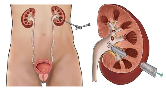 Percutaneous Nephrolithotomy (PCNL)