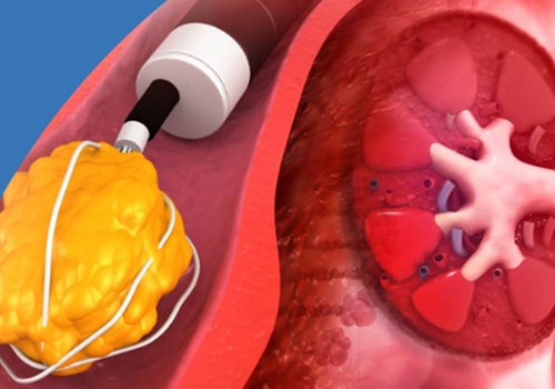 RIRS (Retrograde Intrarenal Surgery)