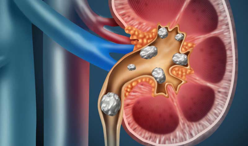 URSL (Ureteroscopic Lithotripsy)